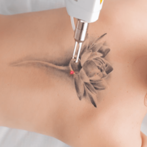 laser haarentfernungskliniken frankfurt Ärzte- und Laser- zentrum | Haarentfernung, Tattooentfernung